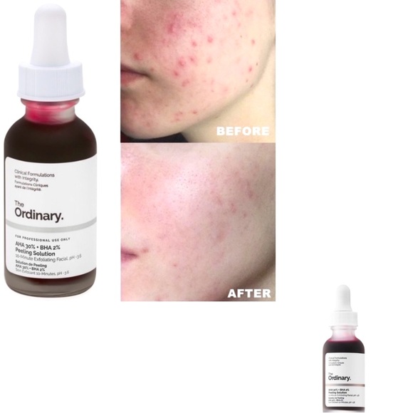 💙💙PEELING SOLUTION - Picture 1 of 2